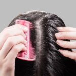 Dandruff and Hair Loss: Is There a Link?