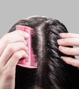 Read more about the article Dandruff and Hair Loss: Is There a Link?