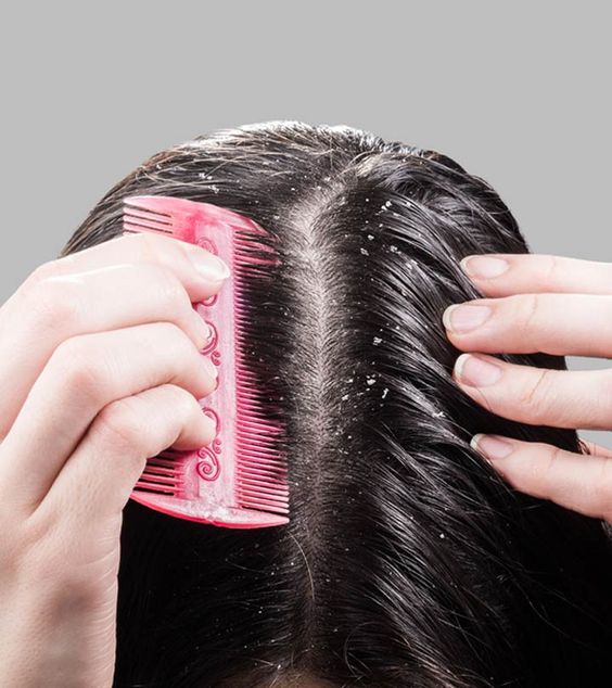 Dandruff and Hair Loss: Is There a Link?